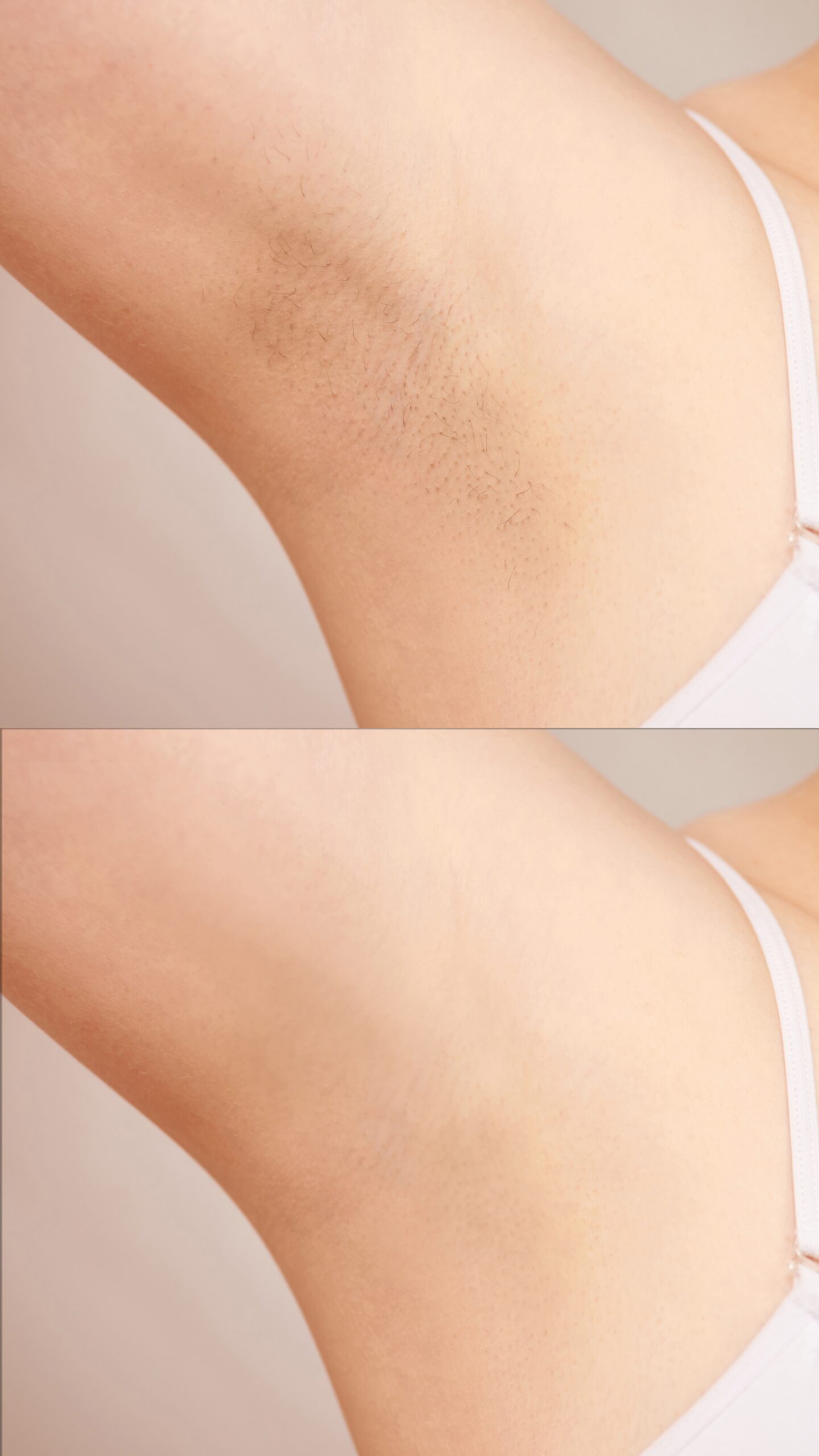 Girl underarm. White woman armpit. Before and after epilation. Wax depilation result. Laser hair removal. sugaring spa procedure