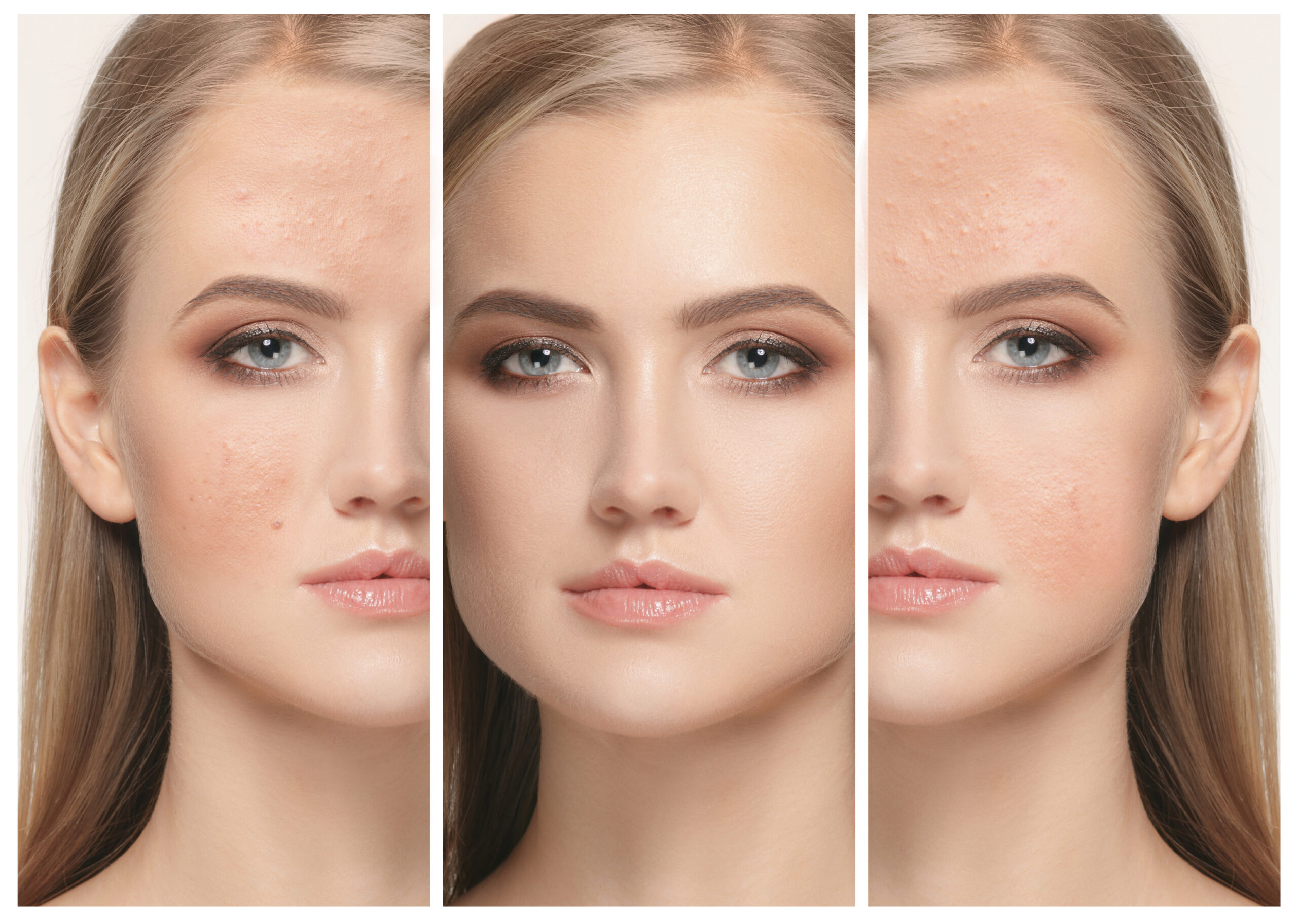 The female face of woman before and after treatment, collage